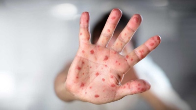 Alerta sanitaria por sarampión: cuatro brotes activos y 500 casos bajo investigación